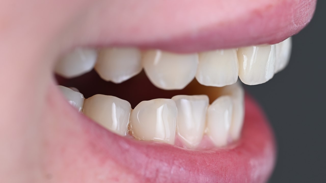 Smile design — sourire naturel