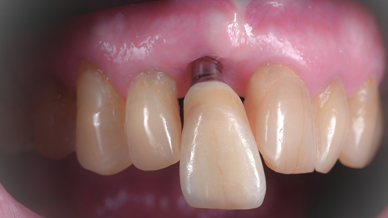 Couronne sur implant dentaire