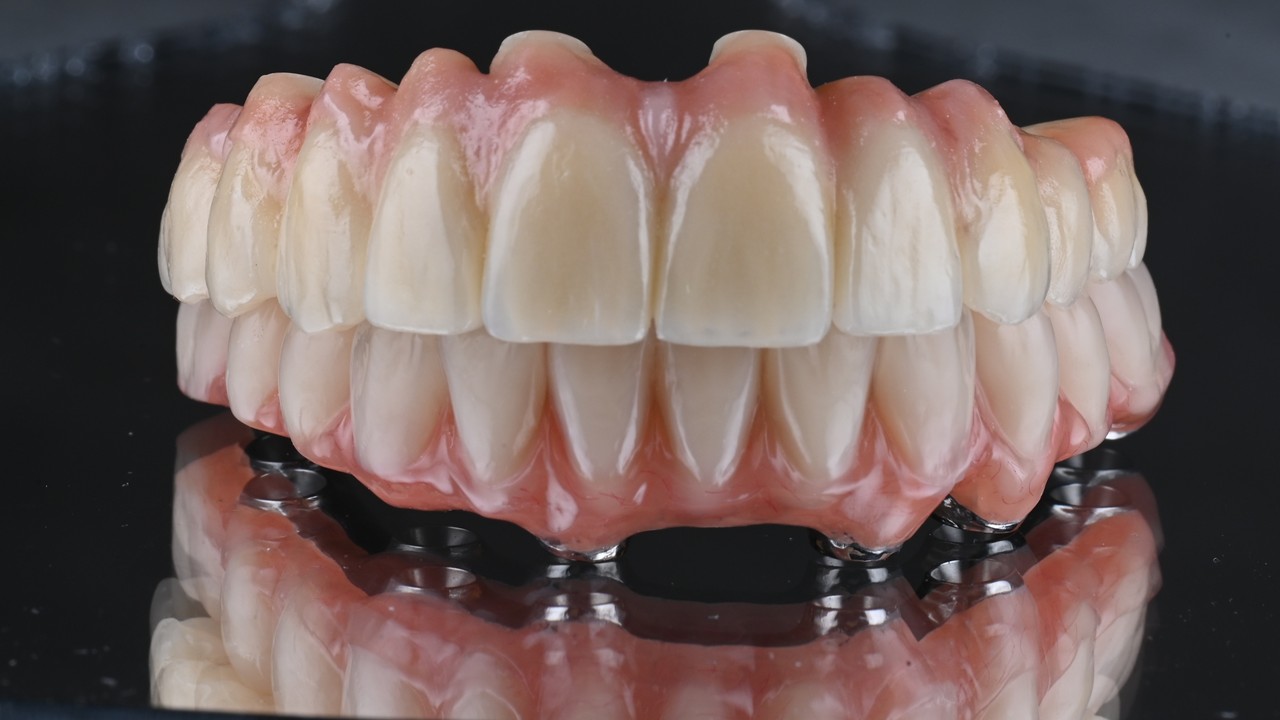 Prothèse complète sur implants — All-on-4