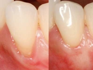 Récession gingivale — avant et après traitement